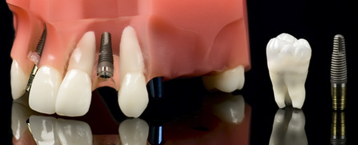 dental implants in nagpur